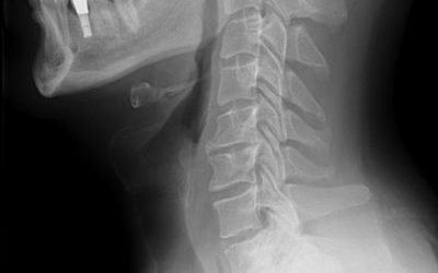 Treating Patients with Cervical Lordosis