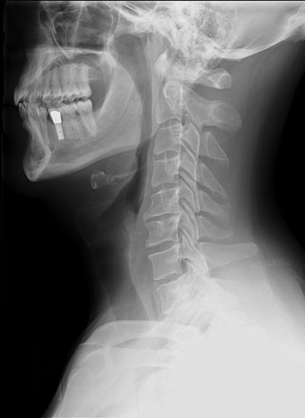 Treating Patients with Cervical Lordosis
