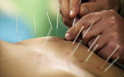 Judge Rules On Physical Therapists Performing  Dry Needling