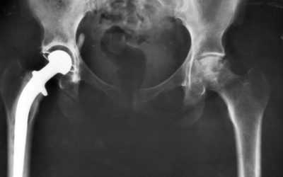 Comprehensive Total Care for Joint Replacement Model